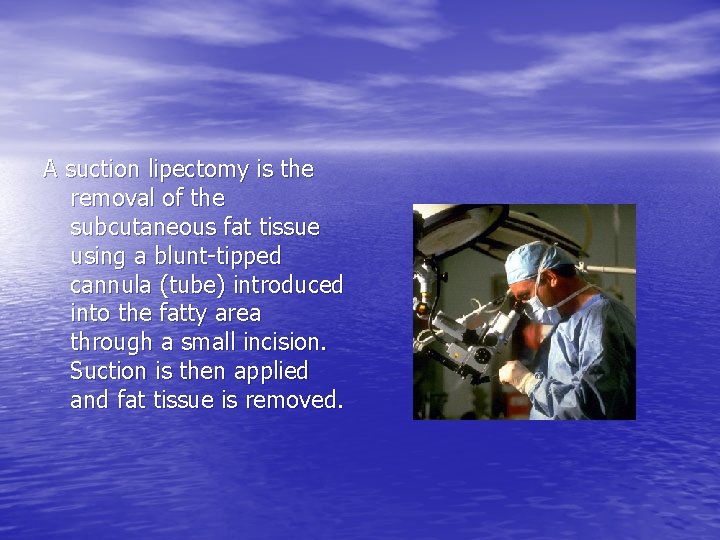 A suction lipectomy is the removal of the subcutaneous fat tissue using a blunt-tipped A suction lipectomy is the removal of the subcutaneous fat tissue using a blunt-tipped