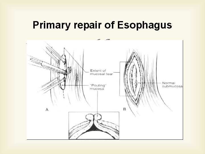 Primary repair of Esophagus 