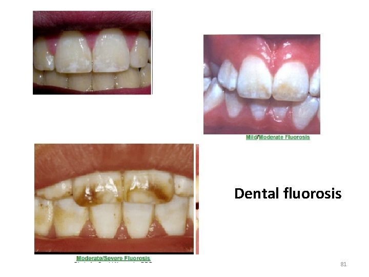 Dental fluorosis 81 