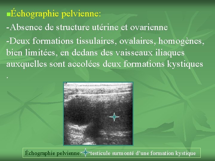 Échographie pelvienne: -Absence de structure utérine et ovarienne -Deux formations tissulaires, ovalaires, homogènes, bien