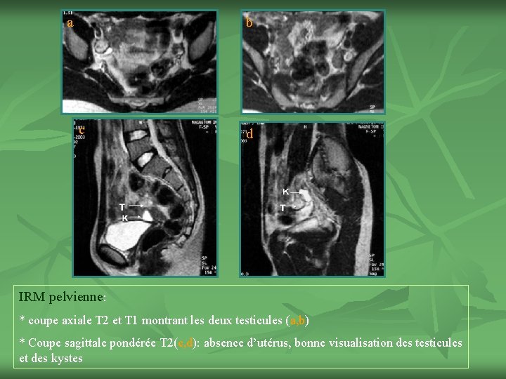 a b c d IRM pelvienne: * coupe axiale T 2 et T 1