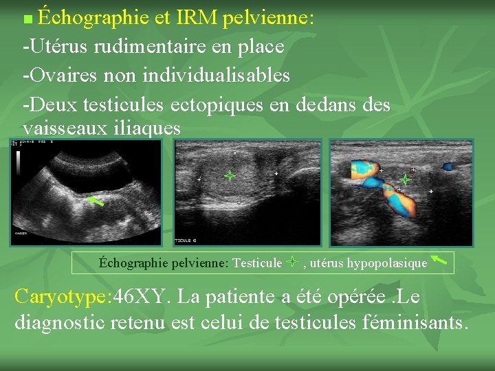Échographie et IRM pelvienne: -Utérus rudimentaire en place -Ovaires non individualisables -Deux testicules ectopiques