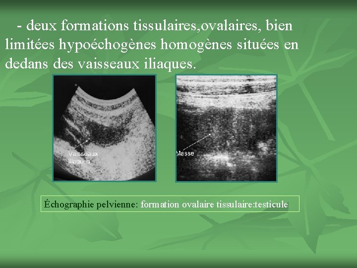 - deux formations tissulaires, ovalaires, bien limitées hypoéchogènes homogènes situées en dedans des vaisseaux