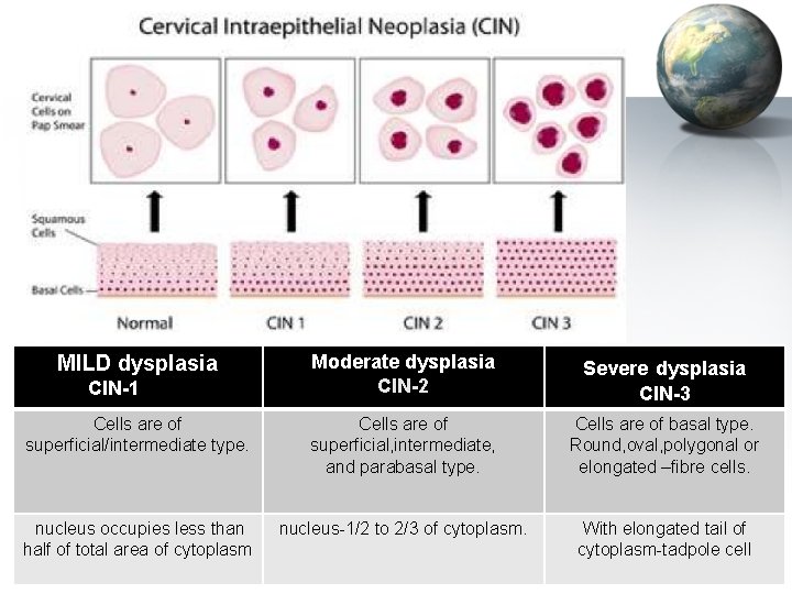 Moderate dysplasia CIN-2 Severe dysplasia CIN-3 Cells are of superficial/intermediate type. Cells are of