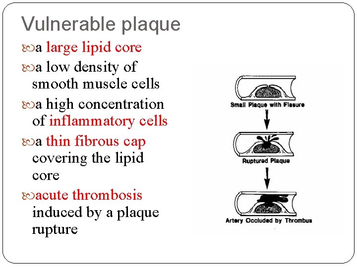 Vulnerable plaque a large lipid core a low density of smooth muscle cells a