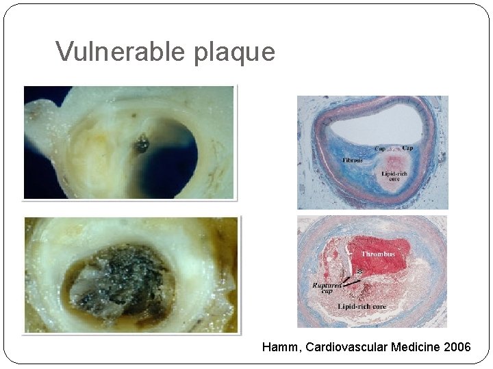 Vulnerable plaque Hamm, Cardiovascular Medicine 2006 