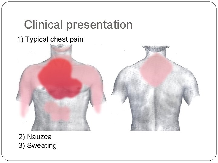 Clinical presentation 1) Typical chest pain 2) Nauzea 3) Sweating 