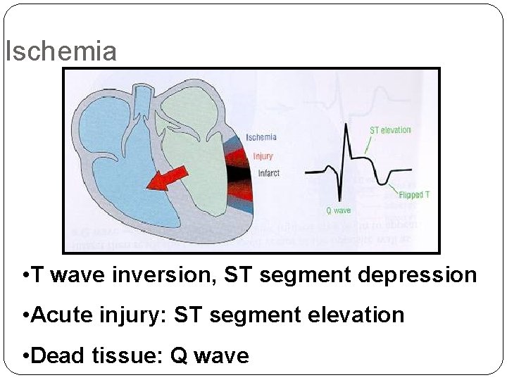 Ischemia • T wave inversion, ST segment depression • Acute injury: ST segment elevation