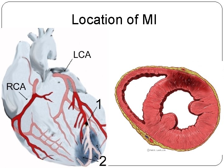 Location of MI 