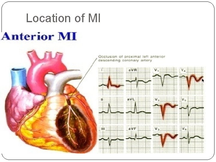 Location of MI 