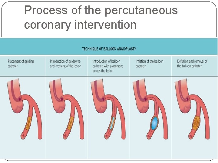 Process of the percutaneous coronary intervention 