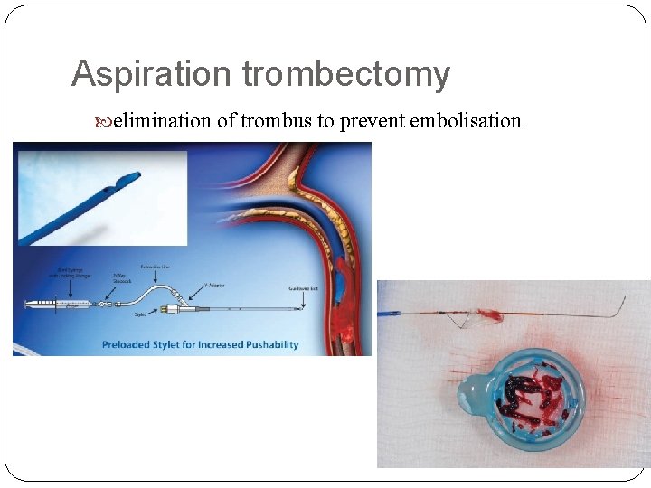 Aspiration trombectomy elimination of trombus to prevent embolisation 