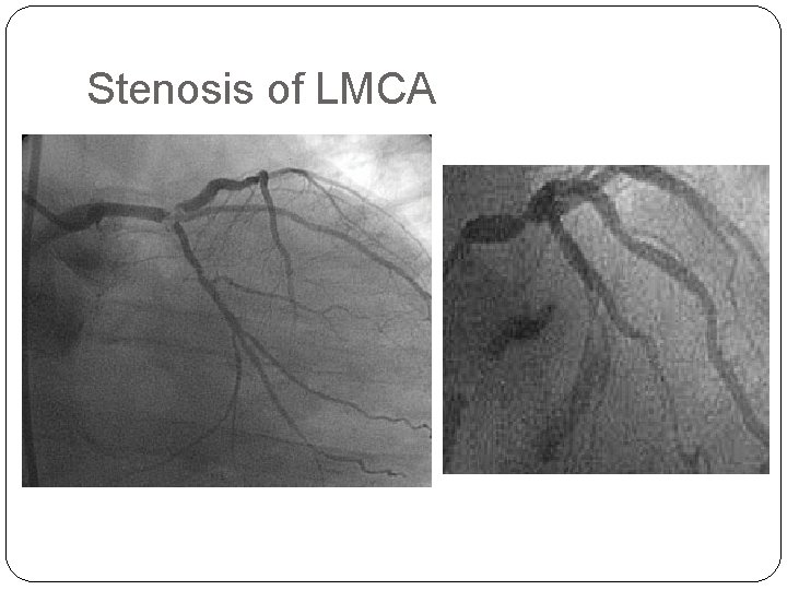 Stenosis of LMCA 