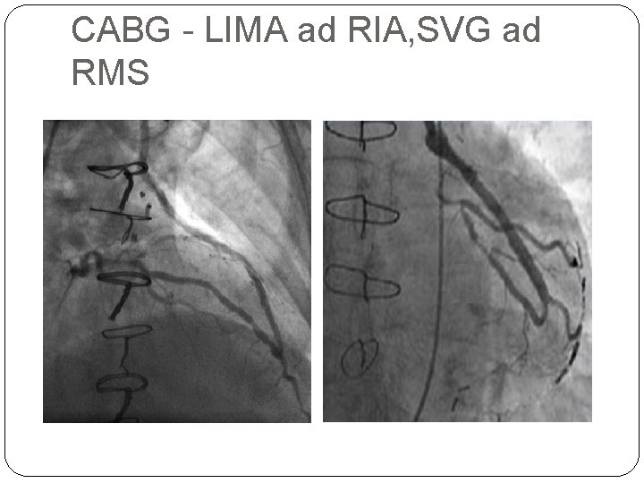 CABG - LIMA ad RIA, SVG ad RMS 