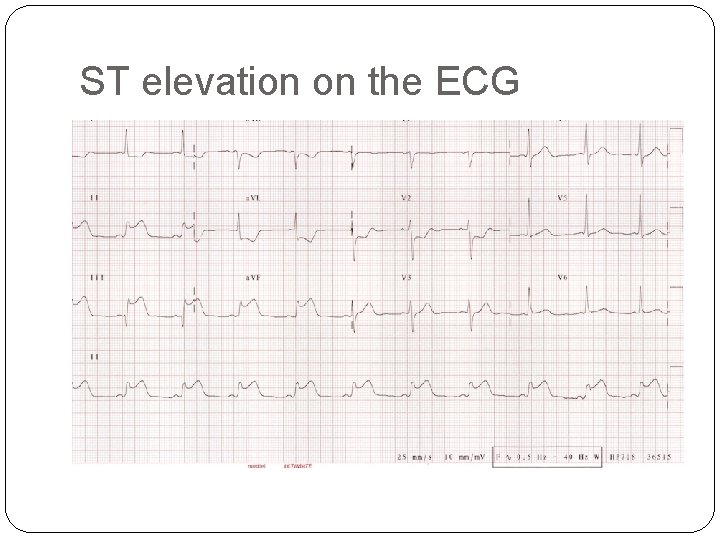 ST elevation on the ECG 