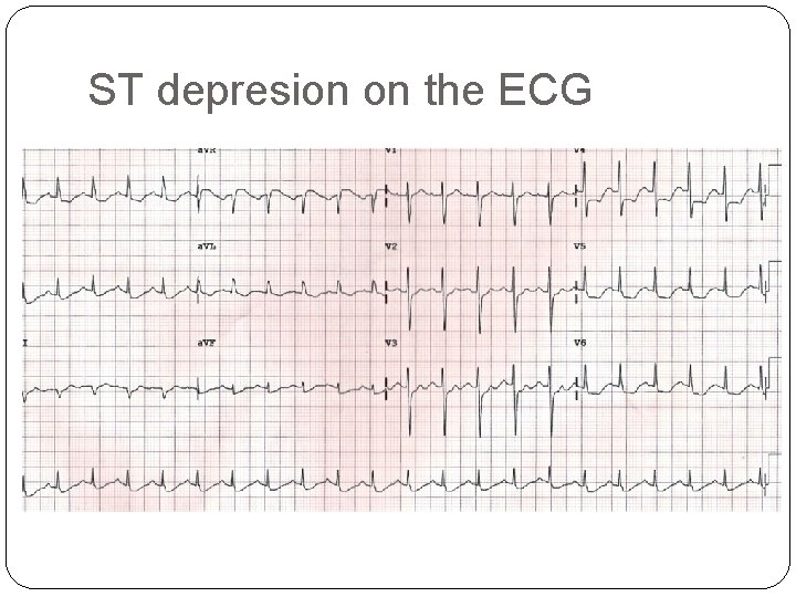 ST depresion on the ECG 