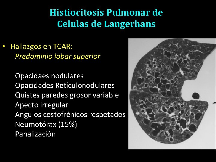 Histiocitosis Pulmonar de Celulas de Langerhans • Hallazgos en TCAR: Predominio lobar superior Opacidaes