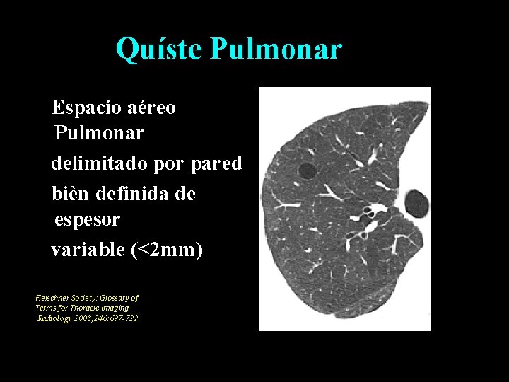 Quíste Pulmonar Espacio aéreo Pulmonar delimitado por pared bièn definida de espesor variable (<2