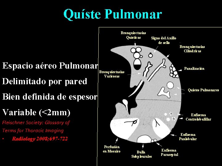 Quíste Pulmonar Bronquiectasias Quísticas Espacio aéreo Pulmonar Delimitado por pared Signo del Anillo de