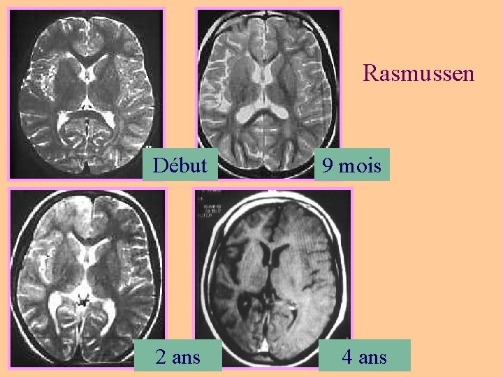 Rasmussen Début 9 mois 2 ans 4 ans 