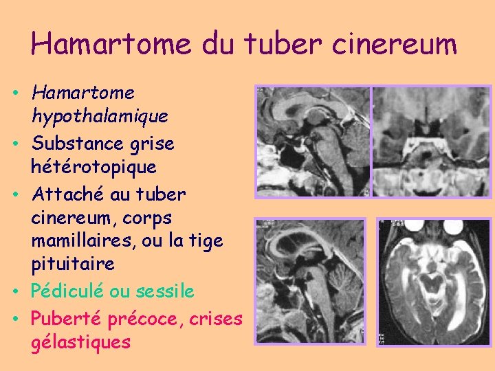 Hamartome du tuber cinereum • Hamartome hypothalamique • Substance grise hétérotopique • Attaché au