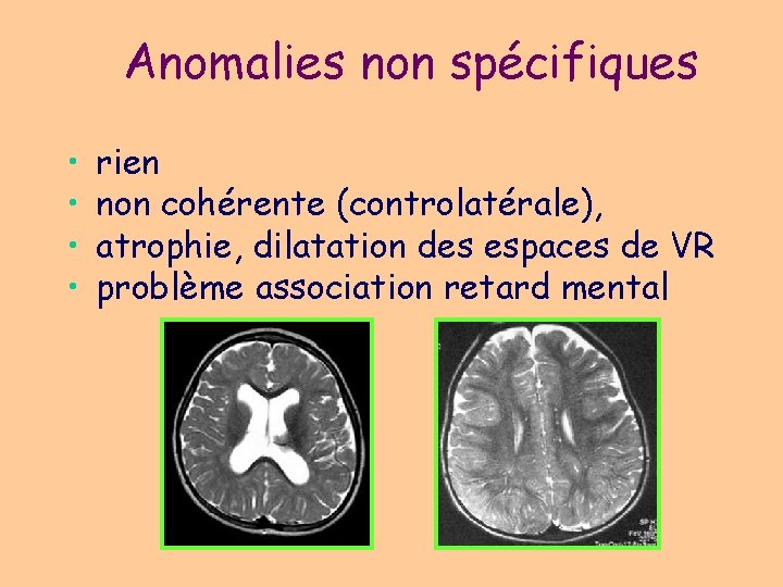 Anomalies non spécifiques • • rien non cohérente (controlatérale), atrophie, dilatation des espaces de