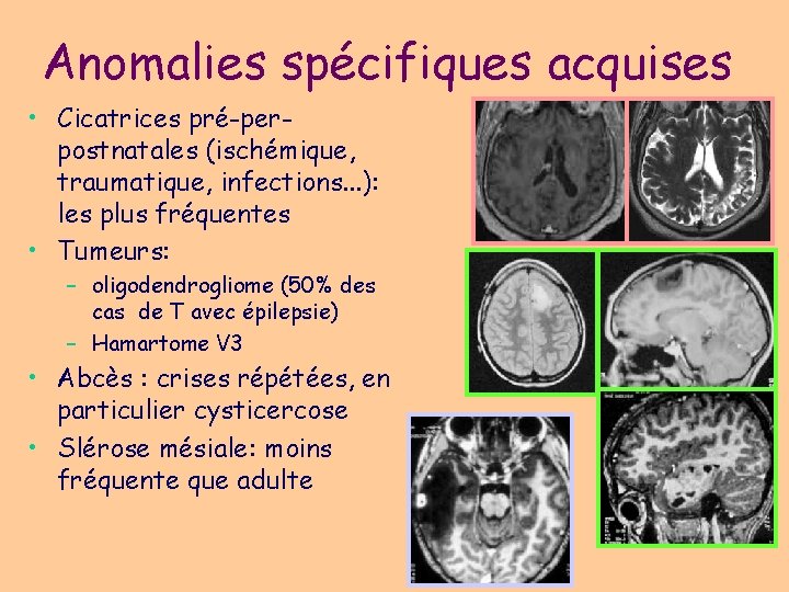 Anomalies spécifiques acquises • Cicatrices pré-perpostnatales (ischémique, traumatique, infections. . . ): les plus