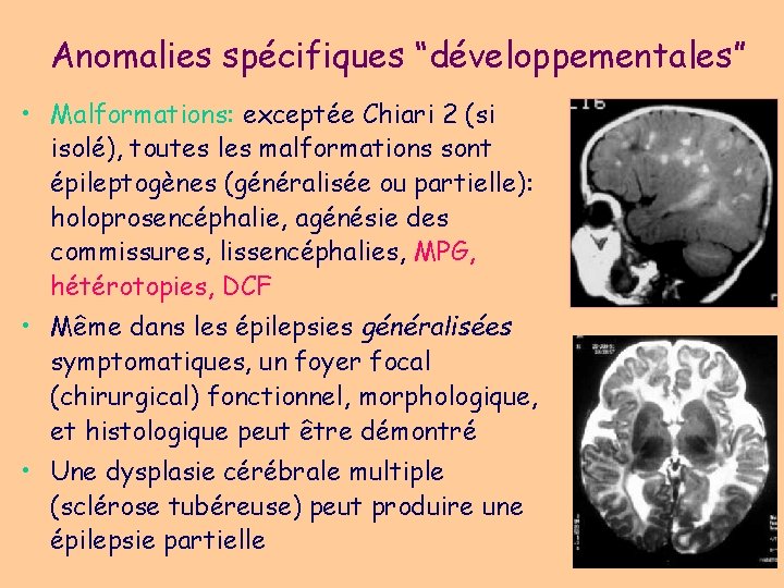 Anomalies spécifiques “développementales” • Malformations: exceptée Chiari 2 (si isolé), toutes les malformations sont