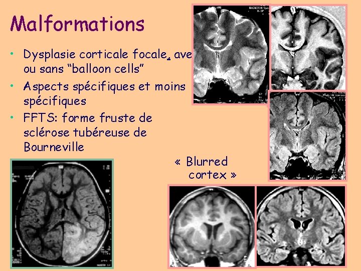 Malformations • Dysplasie corticale focale, avec ou sans “balloon cells” • Aspects spécifiques et