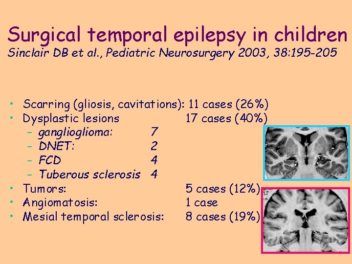 Surgical temporal epilepsy in children Sinclair DB et al. , Pediatric Neurosurgery 2003, 38: