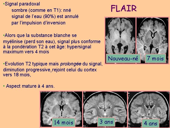  • Signal paradoxal sombre (comme en T 1): nné signal de l’eau (90%)