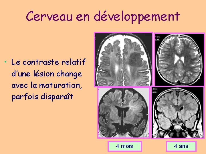 Cerveau en développement • Le contraste relatif d’une lésion change avec la maturation, parfois