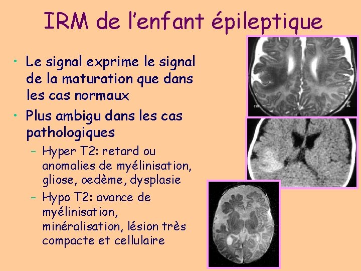 IRM de l’enfant épileptique • Le signal exprime le signal de la maturation que