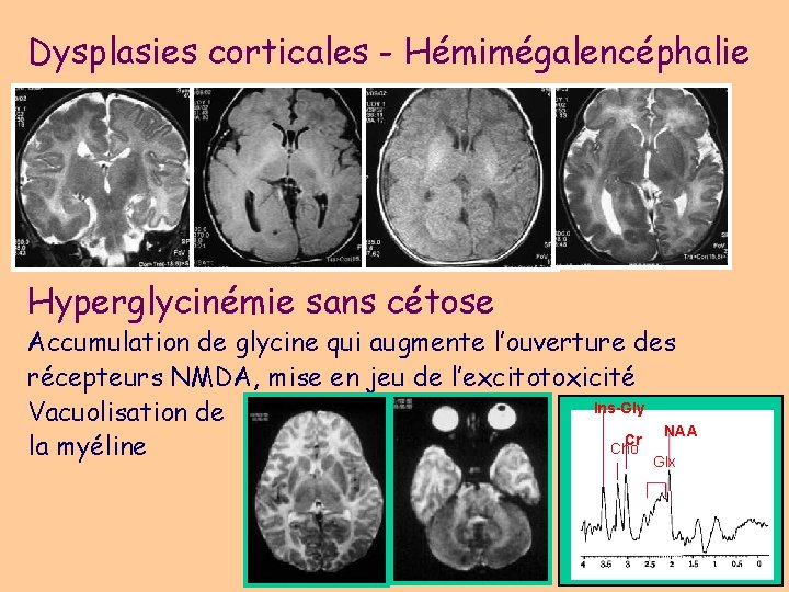 Dysplasies corticales - Hémimégalencéphalie Hyperglycinémie sans cétose Accumulation de glycine qui augmente l’ouverture des