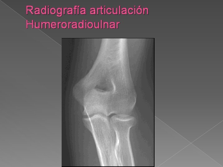Radiografía articulación Humeroradioulnar 