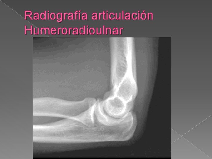 Radiografía articulación Humeroradioulnar 