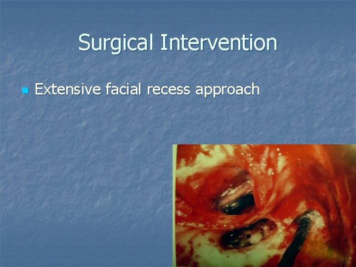 Surgical Intervention n Extensive facial recess approach Surgical Intervention n Extensive facial recess approach
