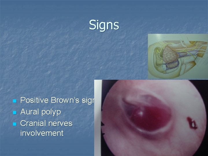 Signs n n n Positive Brown’s sign. Aural polyp Cranial nerves involvement 