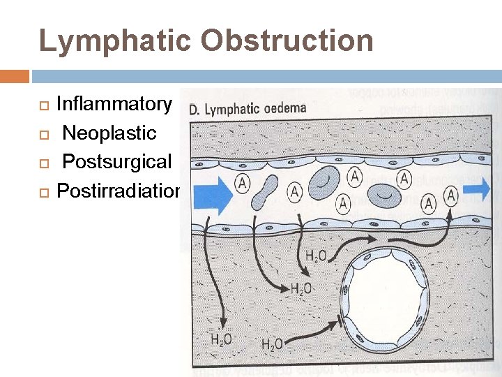 Lymphatic Obstruction Inflammatory Neoplastic Postsurgical Postirradiation Lymphatic Obstruction Inflammatory Neoplastic Postsurgical Postirradiation