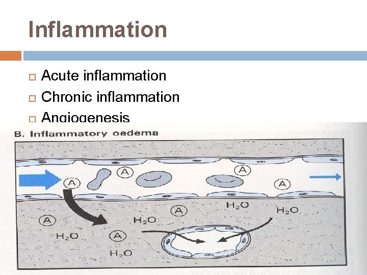 Inflammation Acute inflammation Chronic inflammation Angiogenesis Inflammation Acute inflammation Chronic inflammation Angiogenesis