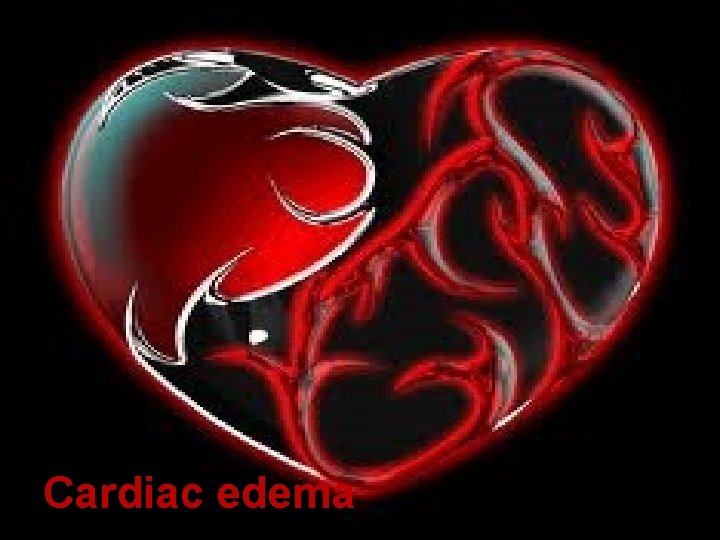 Cardiac edema Cardiac edema