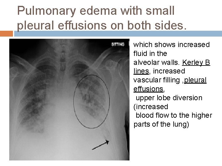 Pulmonary edema with small pleural effusions on both sides. which shows increased fluid in Pulmonary edema with small pleural effusions on both sides. which shows increased fluid in