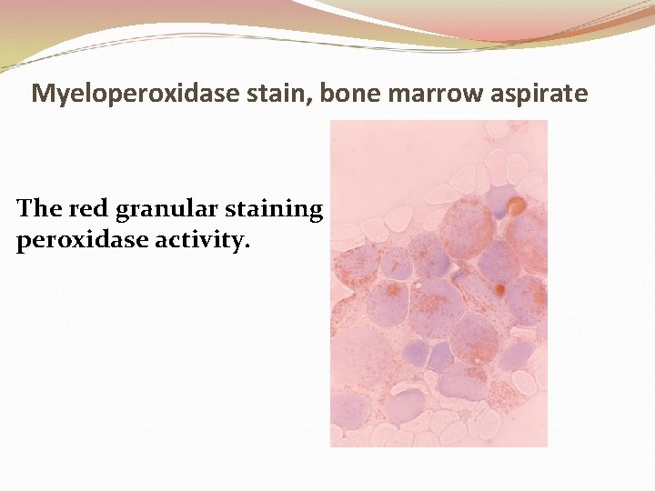 Myeloperoxidase stain, bone marrow aspirate The red granular staining peroxidase activity. 