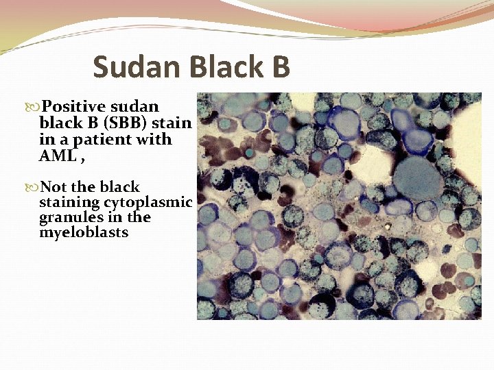 Sudan Black B Positive sudan black B (SBB) stain in a patient with AML