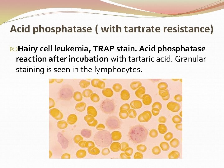 Acid phosphatase ( with tartrate resistance) Hairy cell leukemia, TRAP stain. Acid phosphatase reaction