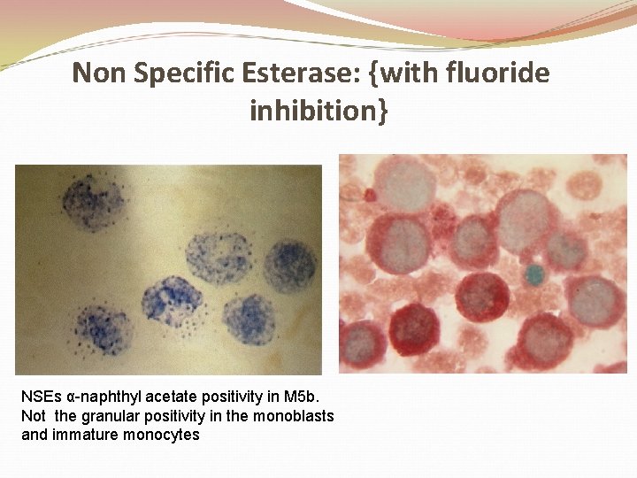 Non Specific Esterase: {with fluoride inhibition} NSEs α-naphthyl acetate positivity in M 5 b.