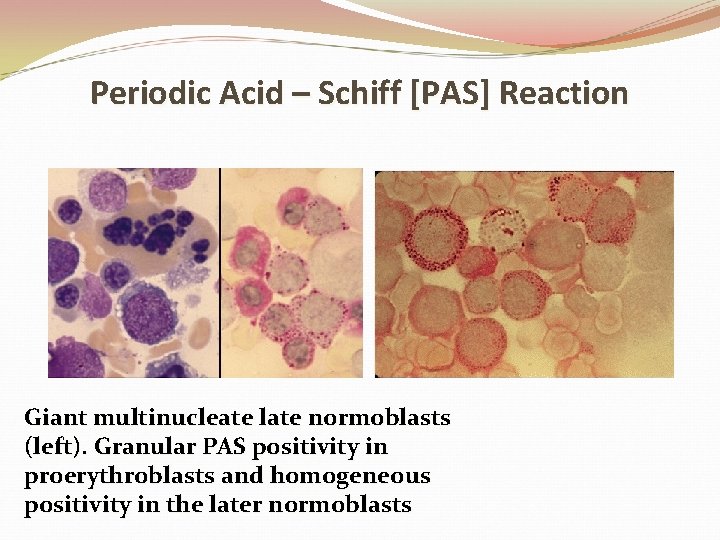 Periodic Acid – Schiff [PAS] Reaction Giant multinucleate late normoblasts (left). Granular PAS positivity