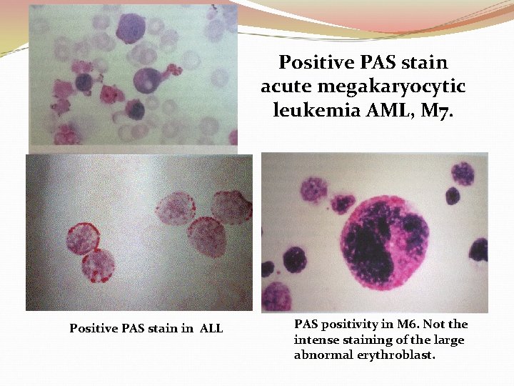 Positive PAS stain acute megakaryocytic leukemia AML, M 7. Positive PAS stain in ALL