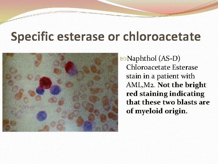 Specific esterase or chloroacetate Naphthol (AS-D) Chloroacetate Esterase stain in a patient with AML,