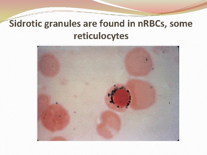 Sidrotic granules are found in n. RBCs, some reticulocytes 